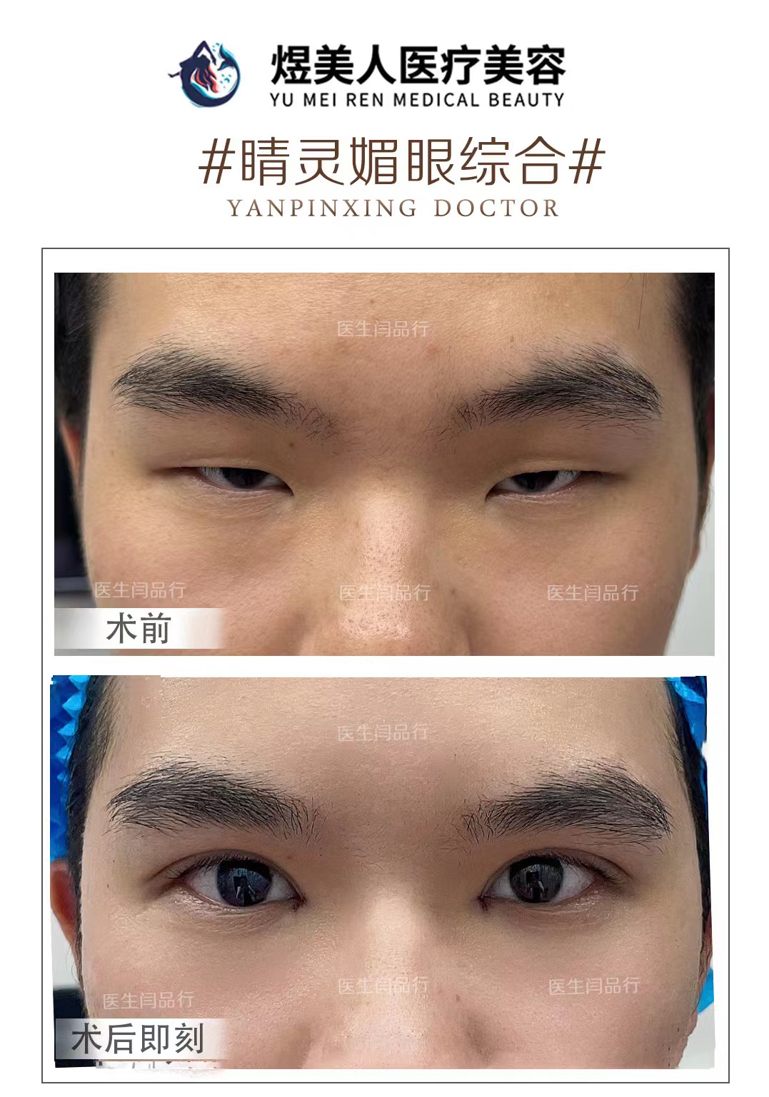 合肥双眼皮医师选择参考