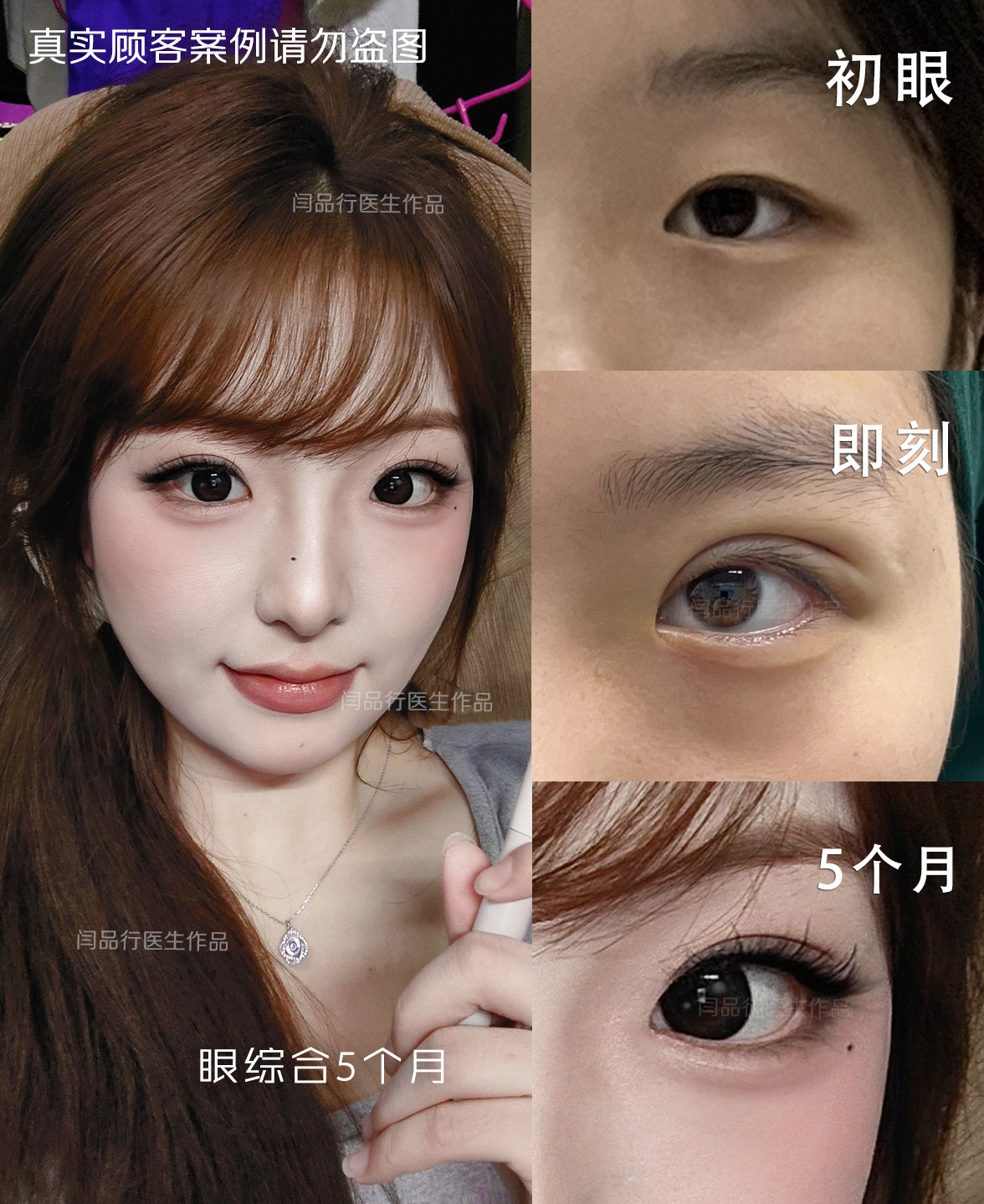 双眼皮术后效果参考