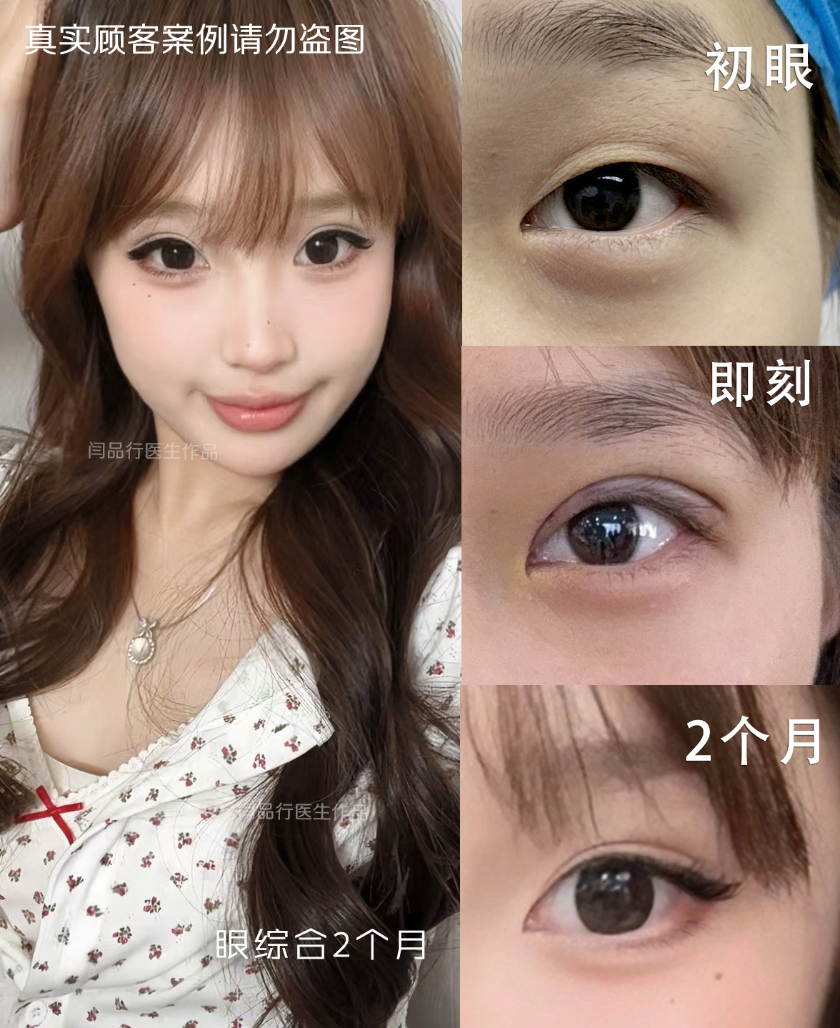 合肥双眼皮医师参考